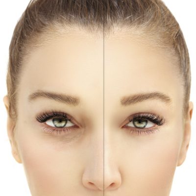 Eliminazione occhiaie con filler