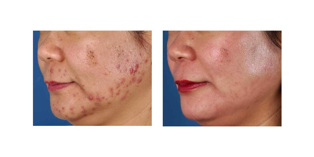 peeling viso acne