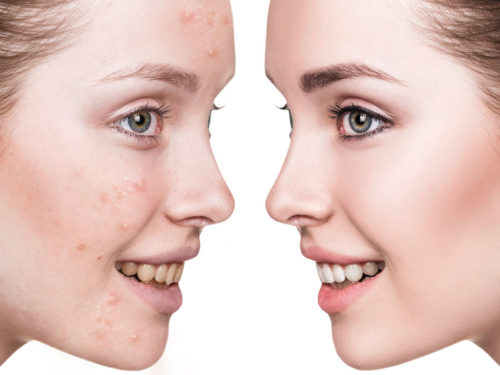 Trattamento Acne Macchie Melasma Zo Skin