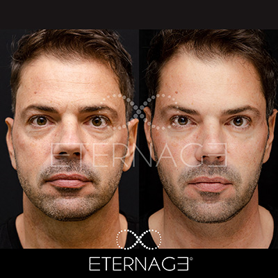 Come ringiovanire il viso con il metodo ETERNAGE