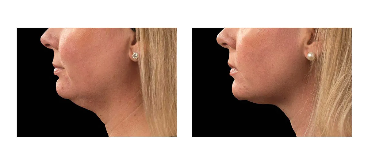 Coolsculpting Viso 1