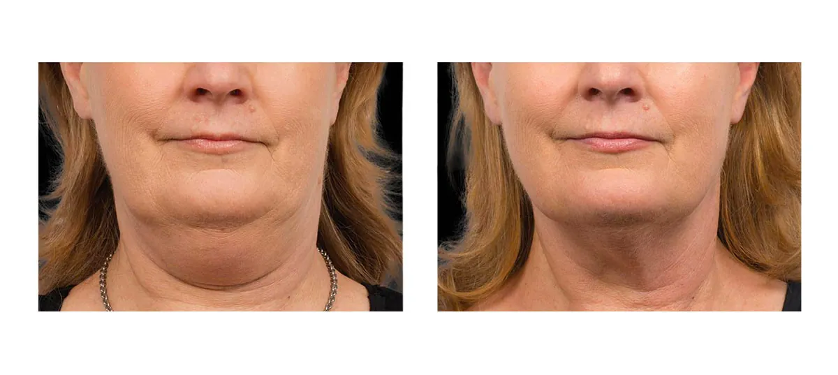 Coolsculpting Viso 2