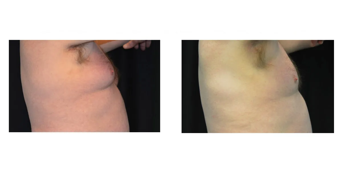 Coolsculpting Ginecomastia 1