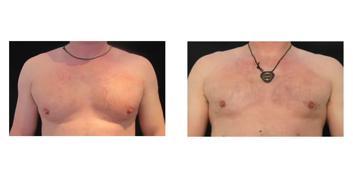 Coolsculpting Ginecomastia 2
