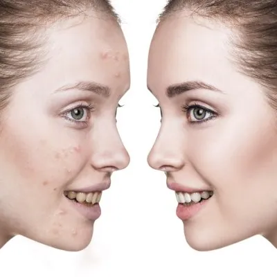 Eliminazione acne, macchie, melasma con Zo Slkin Eliminazione acne, macchie, melasma con Zo Slkin