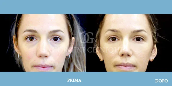 Filler Eliminazione Occhiaie Prima Dopo GIORGINI CLINIQUE Bologna
