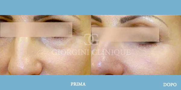 Filler Eliminazione Occhiaie Prima Dopo GIORGINI CLINIQUE Bologna