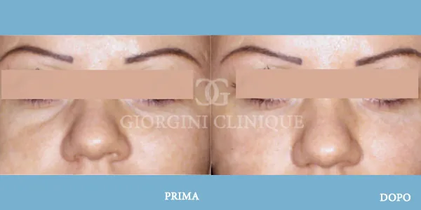 Filler Eliminazione Occhiaie Prima Dopo GIORGINI CLINIQUE Bologna