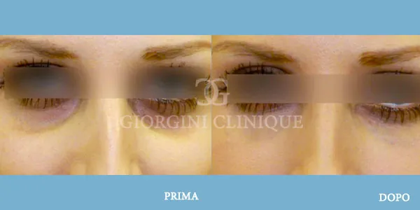 Filler Eliminazione Occhiaie Prima Dopo GIORGINI CLINIQUE Bologna