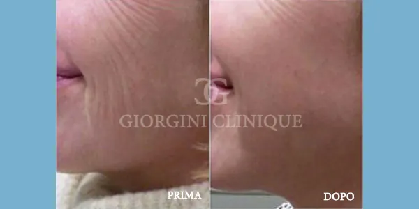 5 Tossina Botulinica Prima Dopo GIORGINI CLINIQUE Bologna
