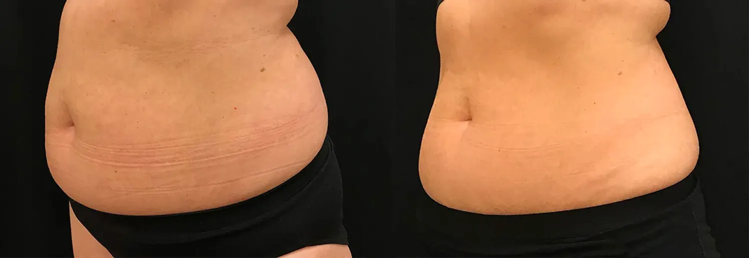 Prima e Dopo il trattamento EVOLVE X di Inmode GIORGINI CLINIQUE Bologna