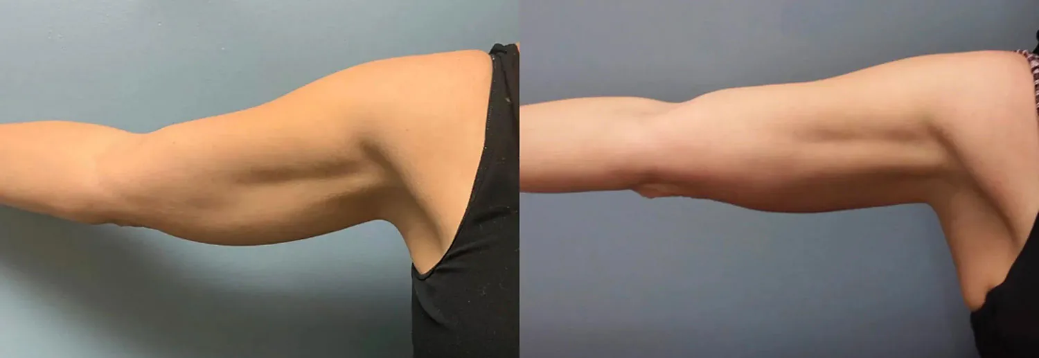 Prima e Dopo il trattamento EVOLVE X di Inmode GIORGINI CLINIQUE Bologna