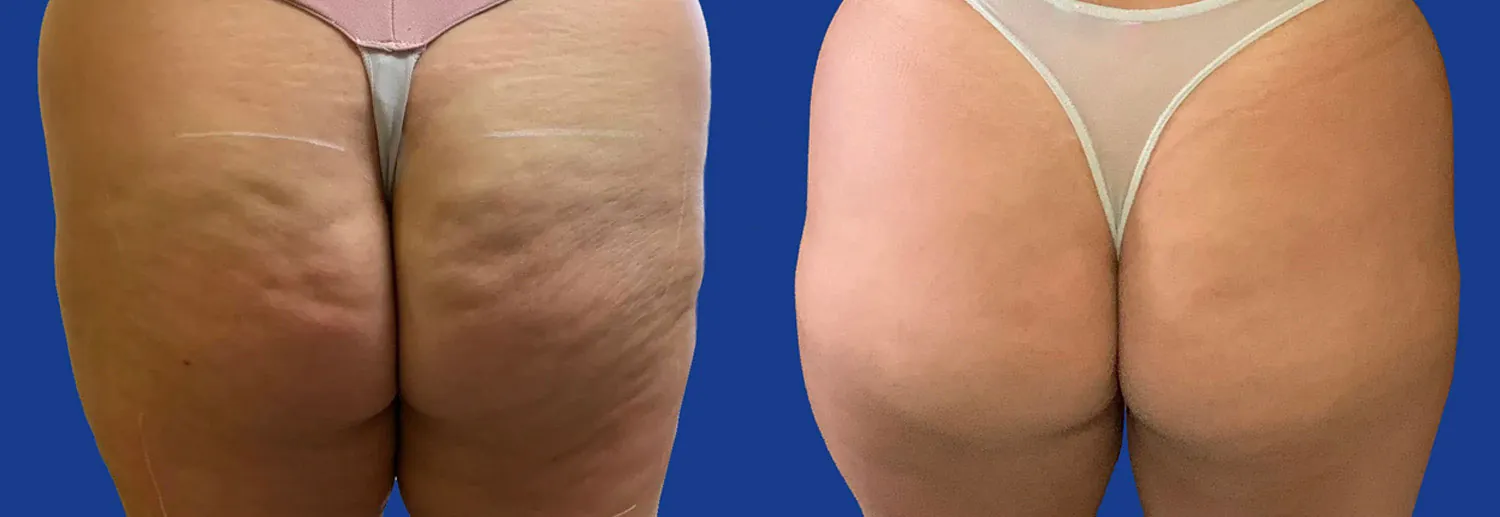 Prima e Dopo il trattamento EVOLVE X di Inmode GIORGINI CLINIQUE Bologna