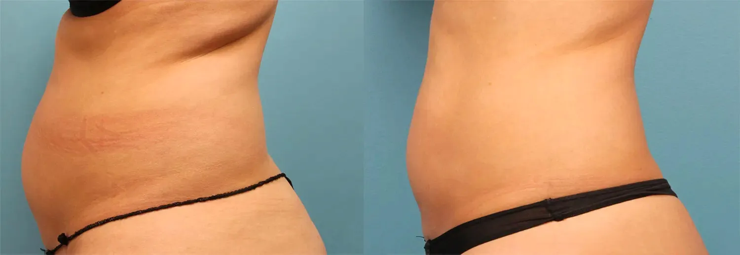 Prima e Dopo il trattamento EVOLVE X di Inmode GIORGINI CLINIQUE Bologna